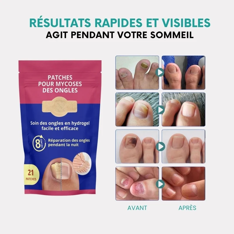 Patch et Sérum contre les Mycoses des Ongles