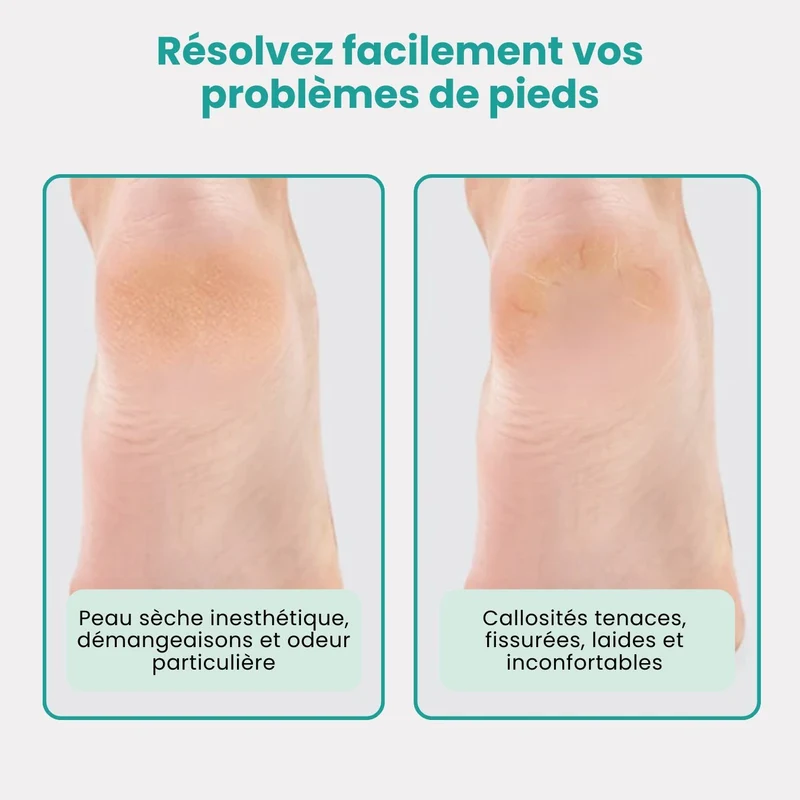 Râpe à Pieds Professionnelle – Élimine Callosités & Peaux Mortes