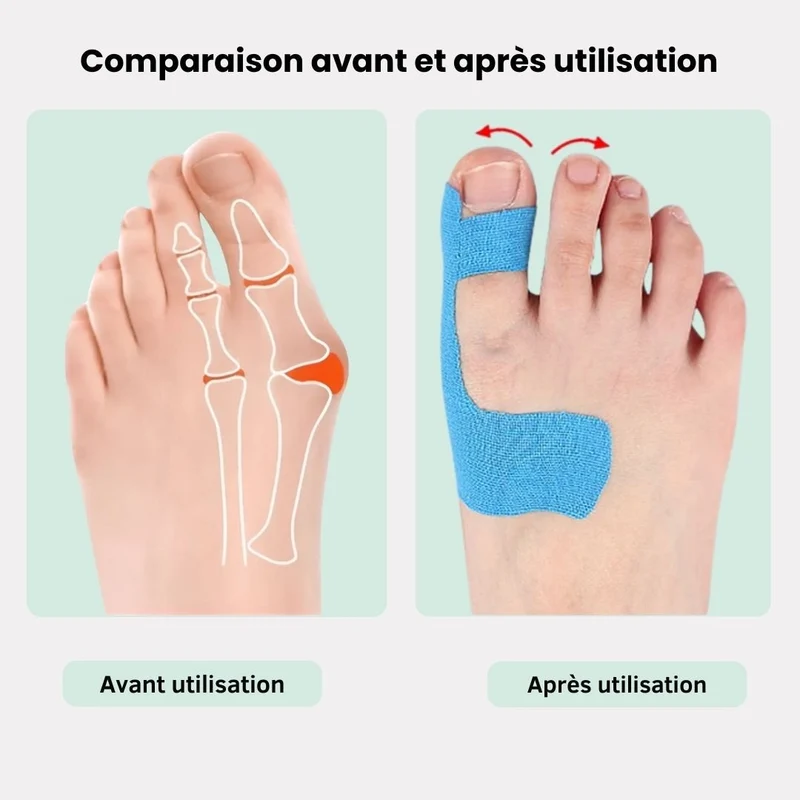 Tape pour Hallux Valgus | Soulagement & Correction