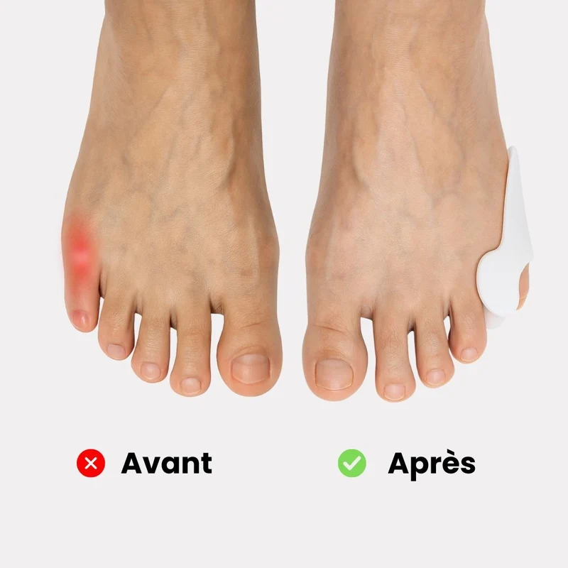 Orthèse Petit Orteil en Silicone
