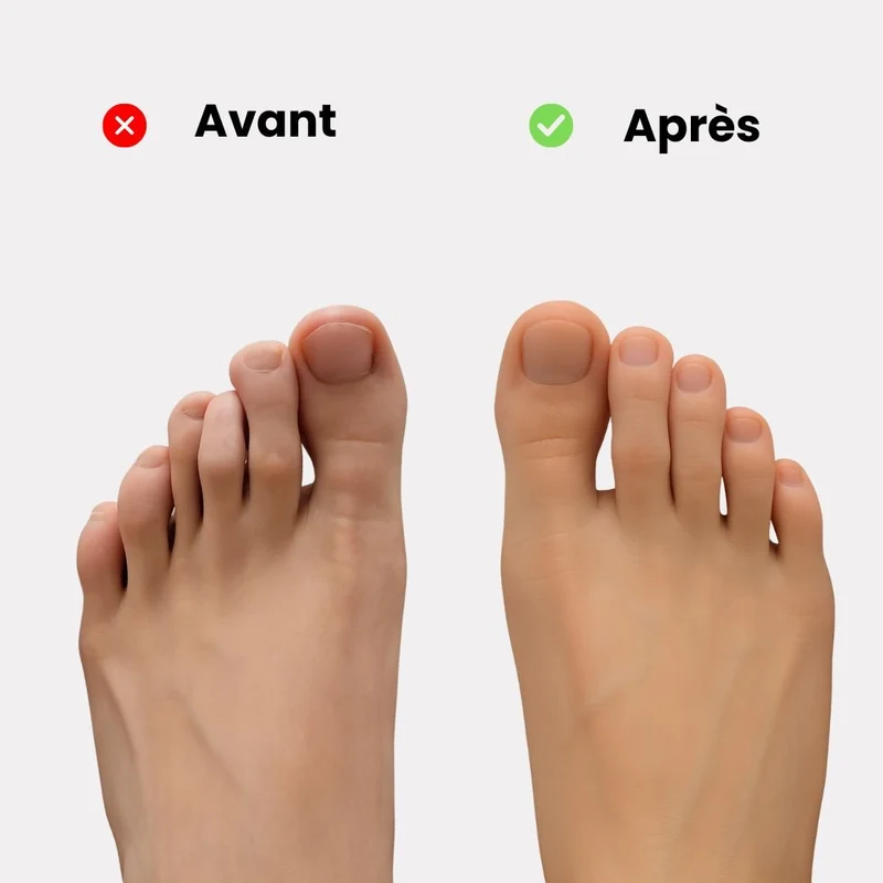 Correcteur d’Orteils en Griffe avec Coussin Plantaire