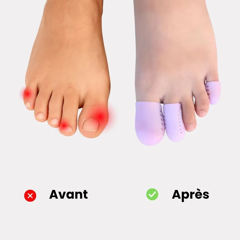 Lot de 3 Orthèses pour les Orteil en Griffe (Taille universelle)