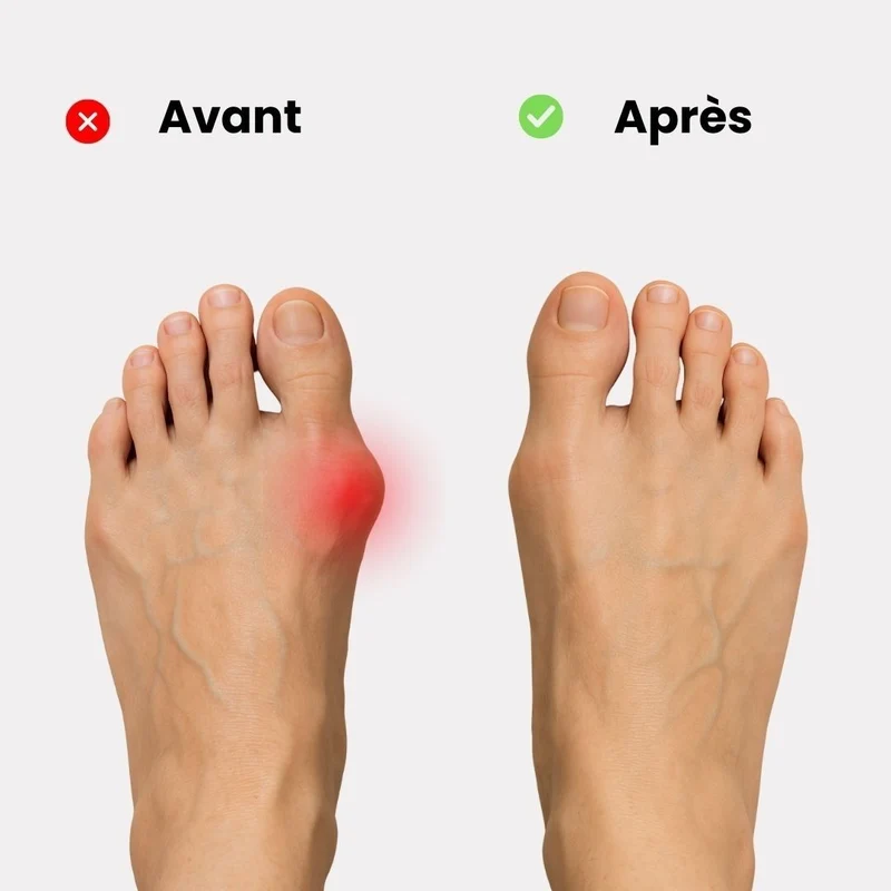 Orthèse orteil souple et discrète pour Hallux Valgus
