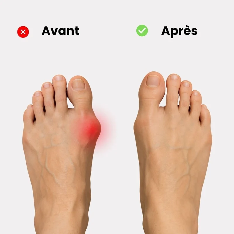 Orhèse hallux valgus de nuit