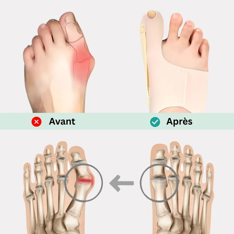 Orthèse Hallux Valgus - Discrète et Légère