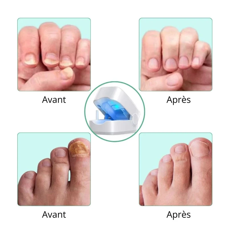 Appareil de Traitement UV des Mycoses