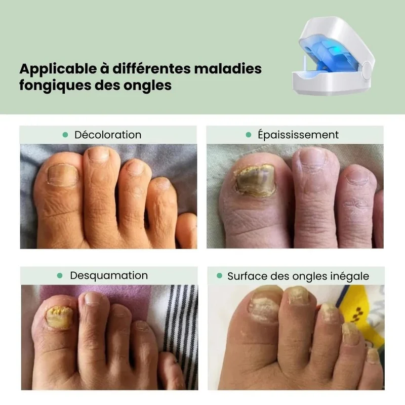 Appareil de Traitement UV des Mycoses