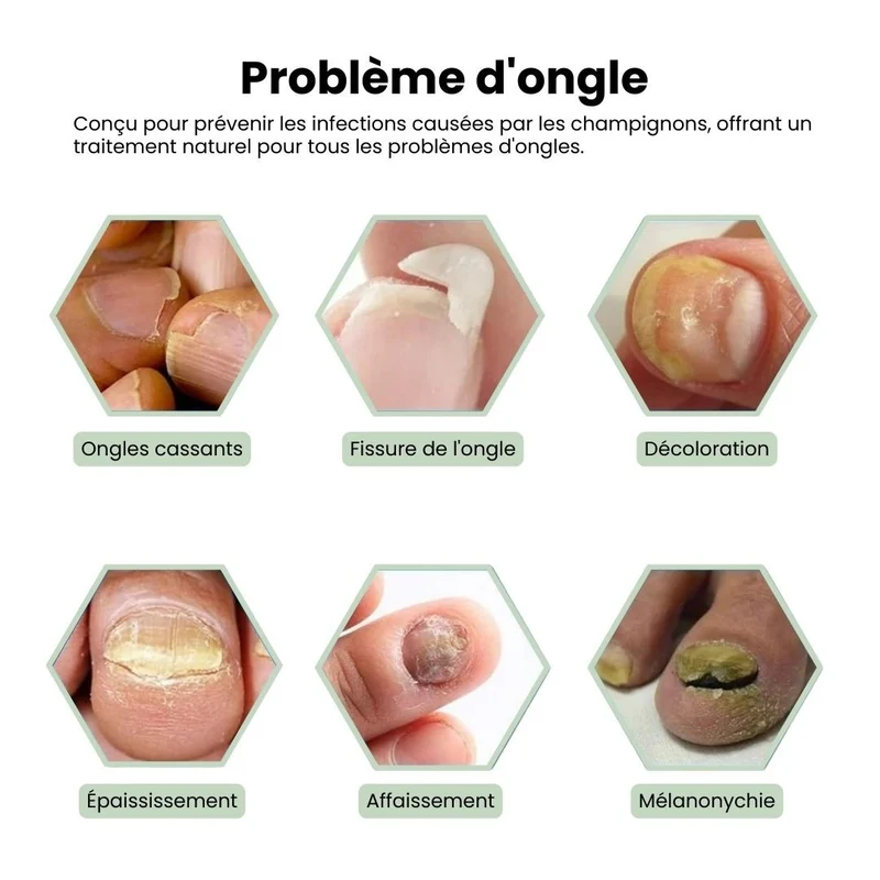 Stylo de traitement des Mycoses Lazer