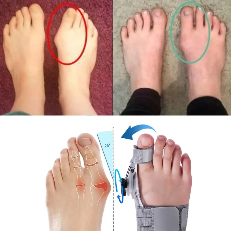 Correcteur Hallux Valgus