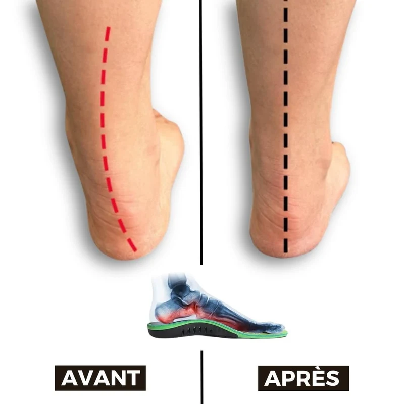 Semelles pour la Fasciite Plantaire